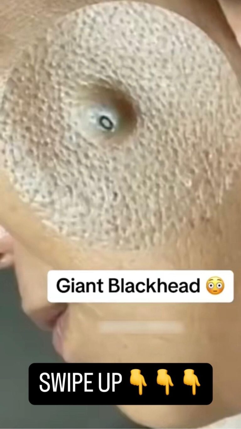 Here are some efficient techniques and skincare advice for treating and preventing blackheads.