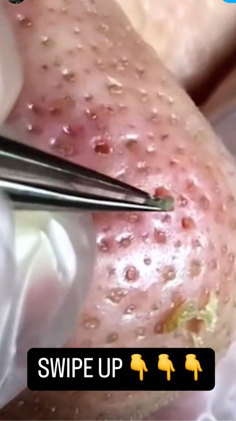 an enlarged image of skin, possibly after extraction for blackheads or acne
