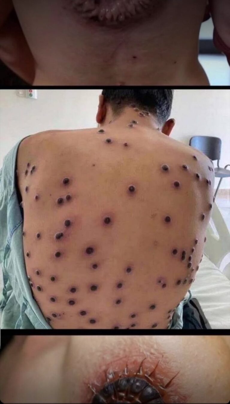 A Visual Guide to Viral Rashes