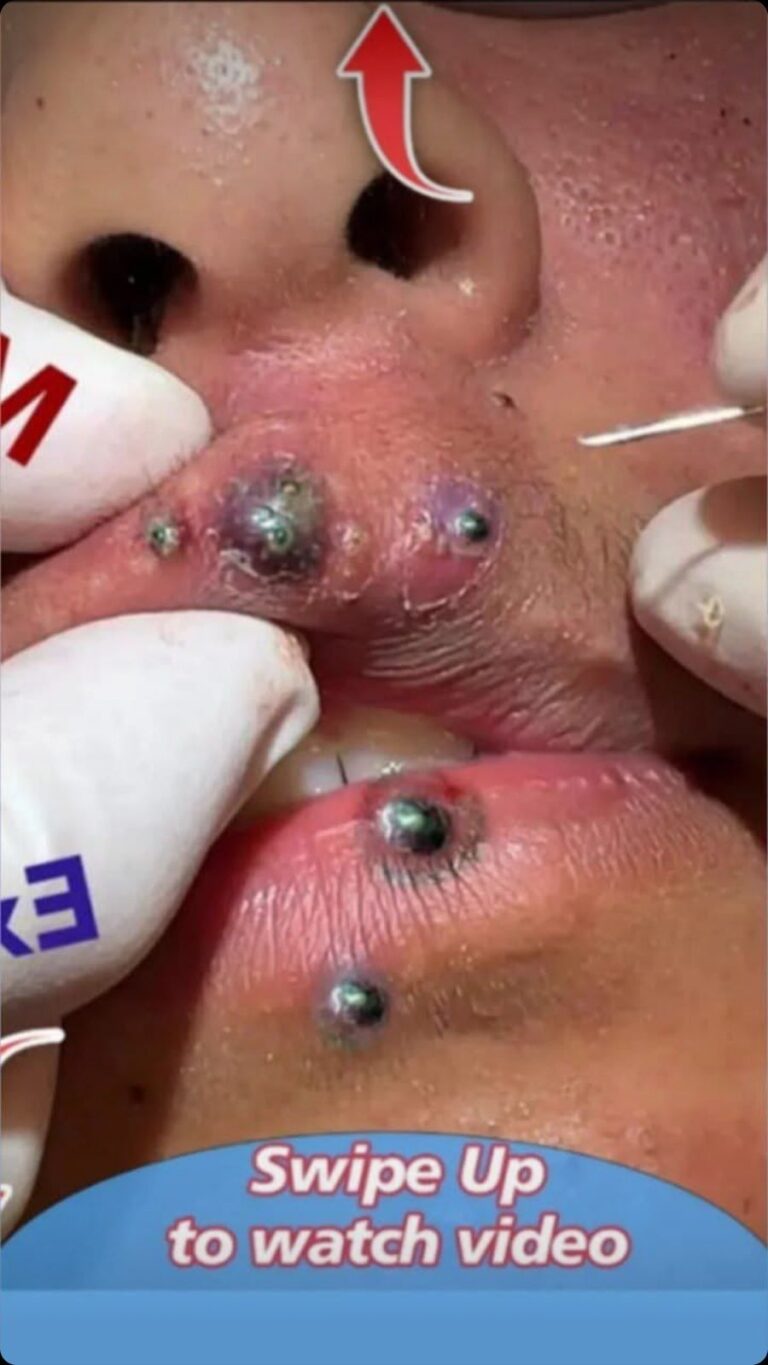 Big Cystic Acne Blackheads Extraction Blackheads & Milia, Whiteheads Removal Pimple Popping