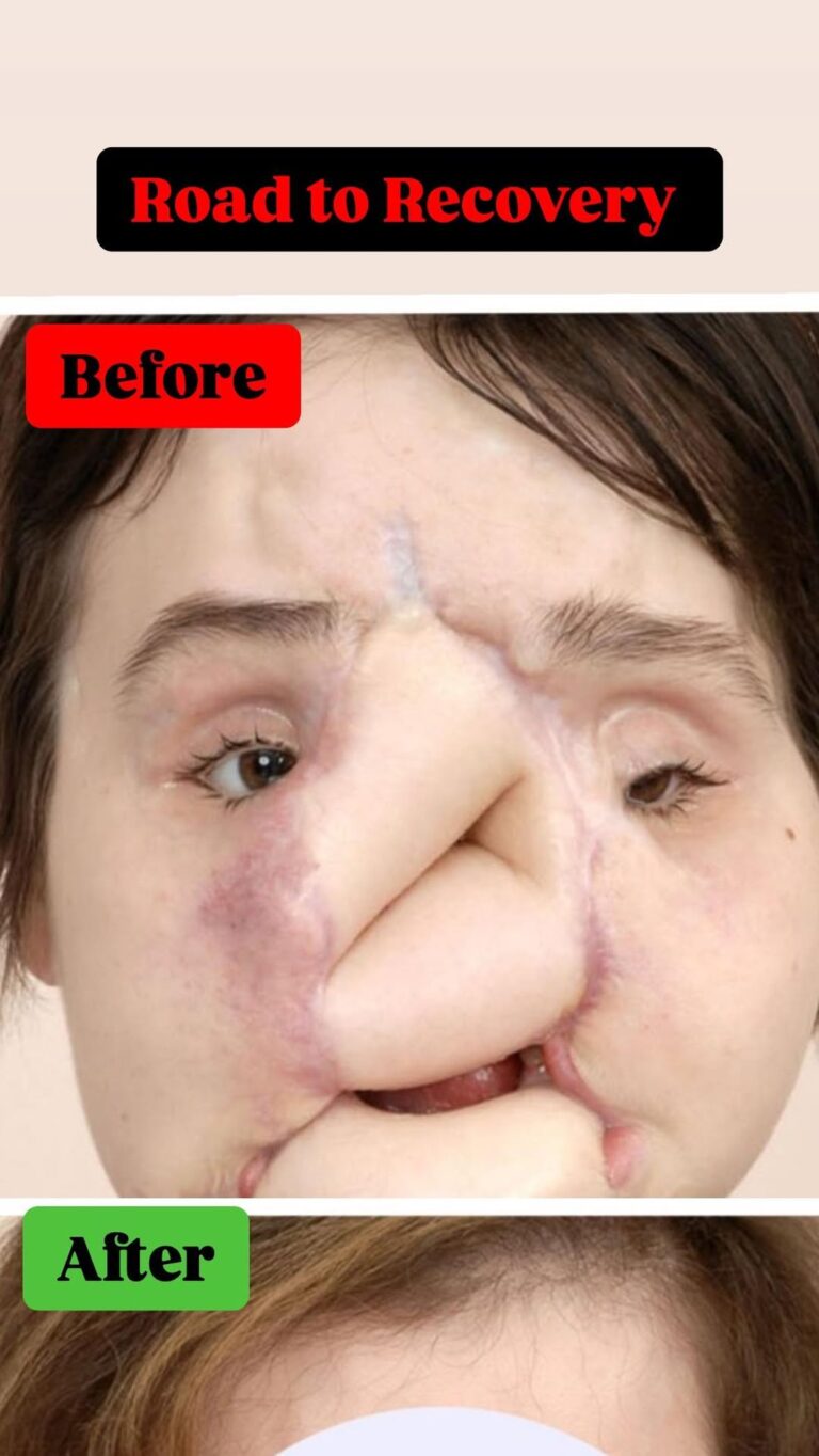 ST, Road to Recovery: The youngest face transplant recipient in the United States is a woman…