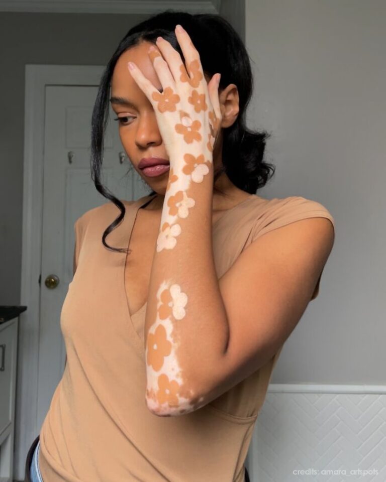 Dancer-Turned-Artist Amara Aleman Turns Her Vitiligo Into Vibrant Body Art (20 Pics)